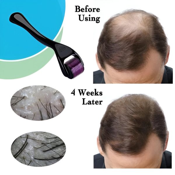 Derma Roller for Hair Regrowth & Skin – Microneedle Therapy for Men & Women